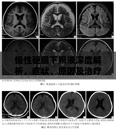 慢性硬膜下积液深度解析,症状、原因及治疗方法